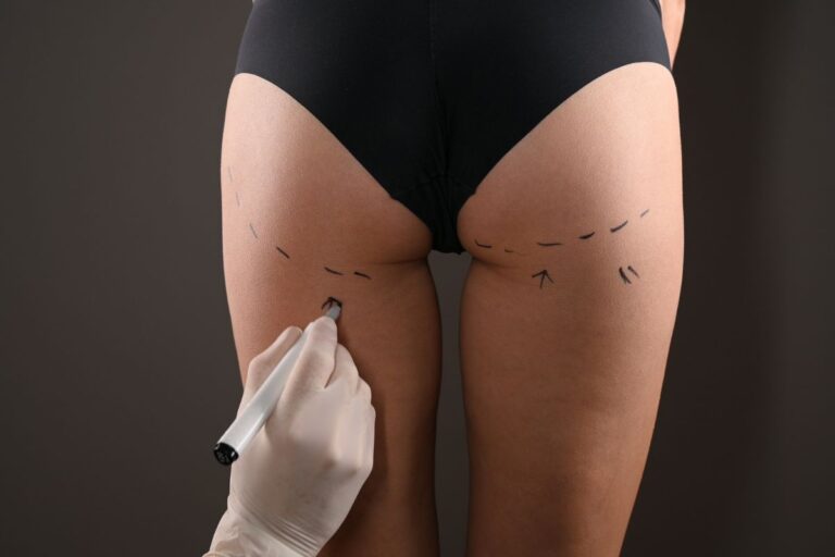 correcao de assimetrias gluteas