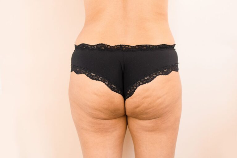 mitos sobre a celulite